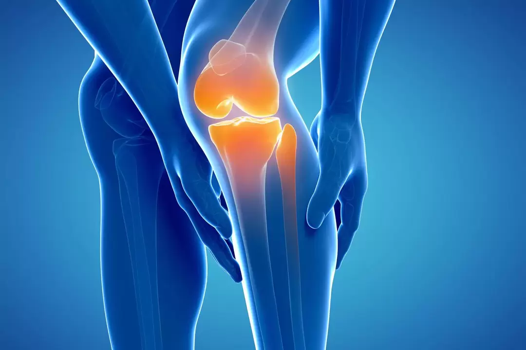 Остеоартроз коленного сустава (гонартроз, деформирующий артроз)